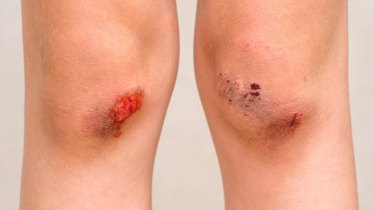 Children injury. Deep scratches on the skin with bruises on the child knees. Wounds, scratches, abrasions on the child leg.