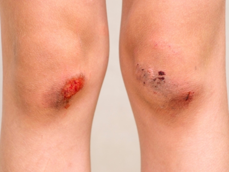 Children injury. Deep scratches on the skin with bruises on the child knees. Wounds, scratches, abrasions on the child leg.