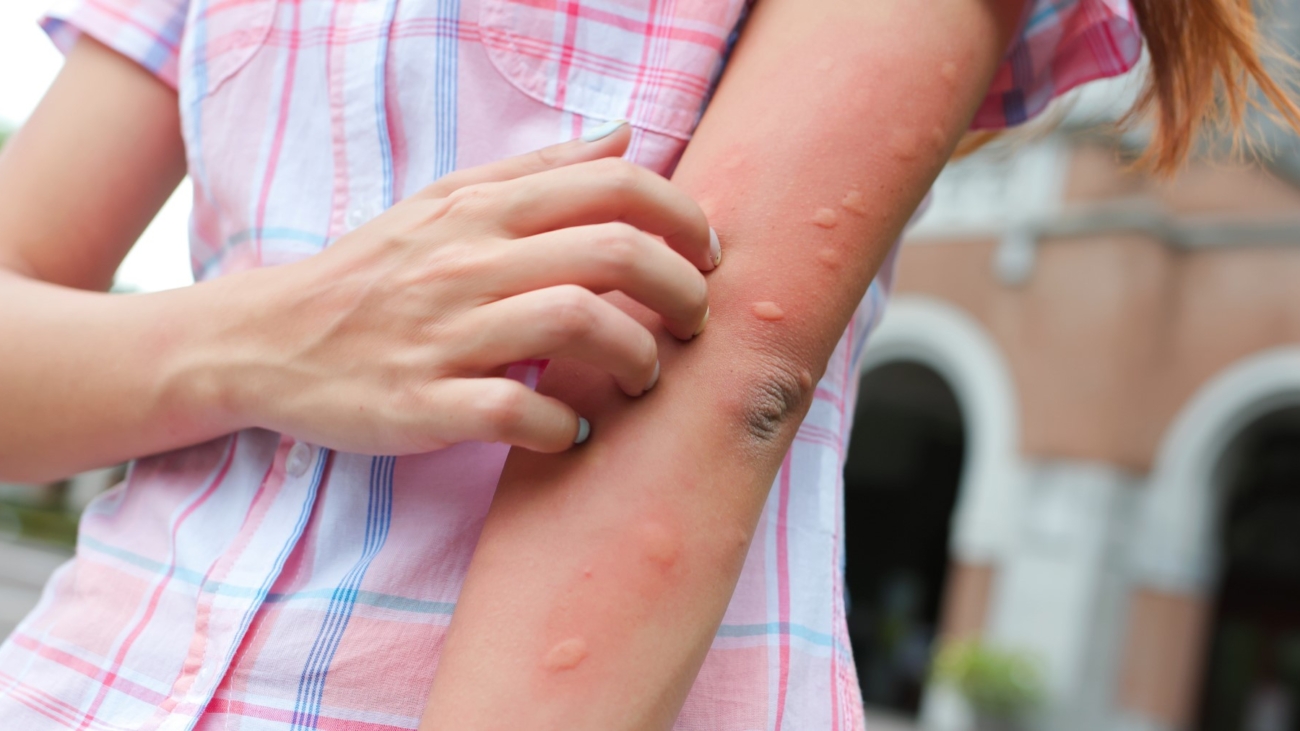 Arm of gilr is bitten by the mosquito and get bumps on her skin  in the summer