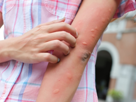 Arm of gilr is bitten by the mosquito and get bumps on her skin  in the summer
