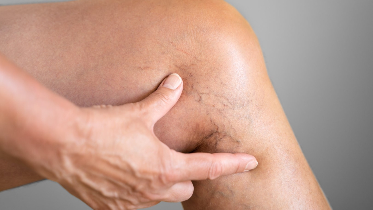 Leg Vein Varicose Disease And Pain. Blood Pressure Problem