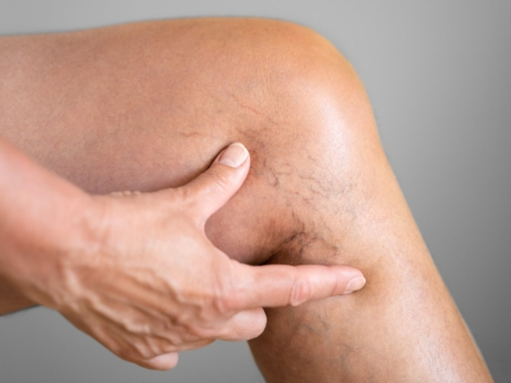 Leg Vein Varicose Disease And Pain. Blood Pressure Problem